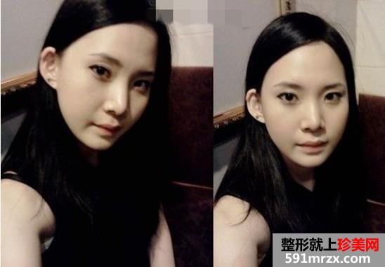 【真人案例】颧骨+下巴+眼睛+鼻子一次搞定