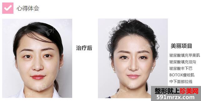有图有真相,玻尿酸,轻松,告别,方脸