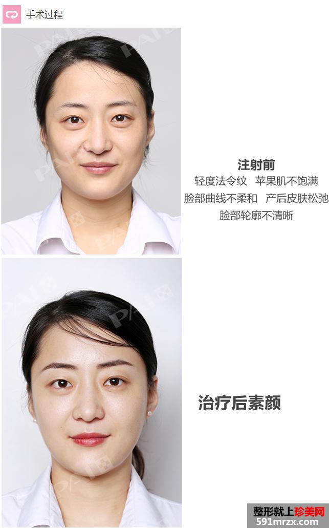 有图有真相,玻尿酸,轻松,告别,方脸