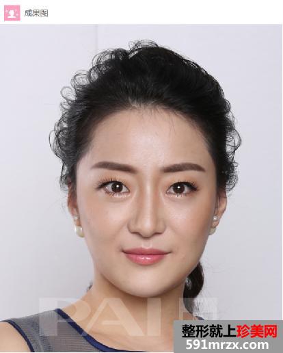 有图有真相,玻尿酸,轻松,告别,方脸