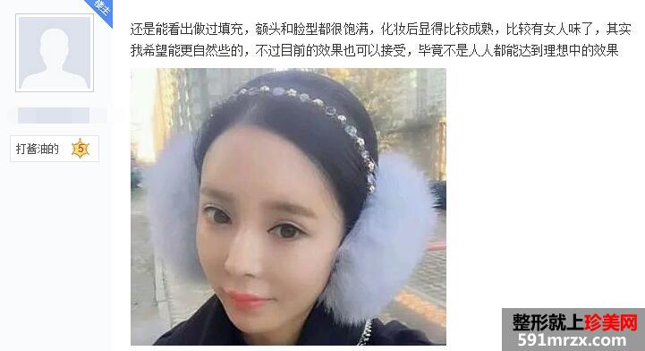 做了脸部自体脂肪填充 现在照相非常上镜