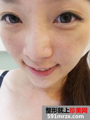 皮秒,激光,祛斑,真实,效果,结痂,过程,照片