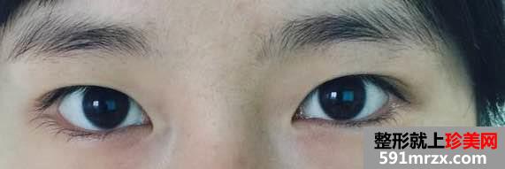 上海喻德军三点式双眼皮技术很好