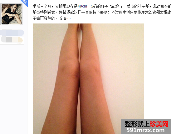 做了大腿吸脂手术 三个月瘦了八公分