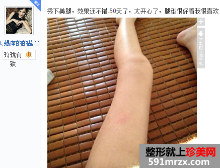 做了大腿吸脂手术 三个月瘦了八公分