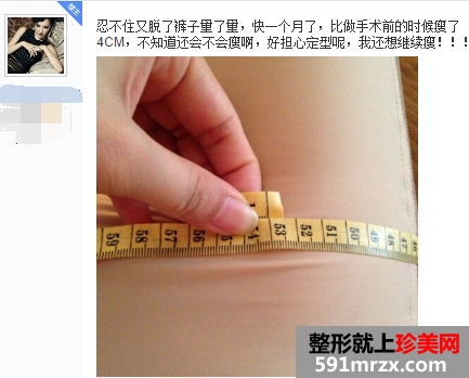 做了大腿吸脂手术 三个月瘦了八公分