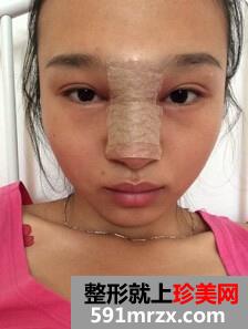 膨体隆鼻需要几天恢复
