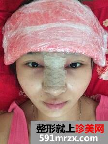 膨体隆鼻需要几天恢复
