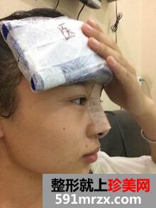 膨体隆鼻需要几天恢复