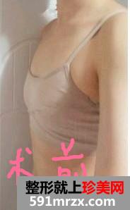 300cc高凝聚性硅胶假体隆胸手术前后对比效果图片分享