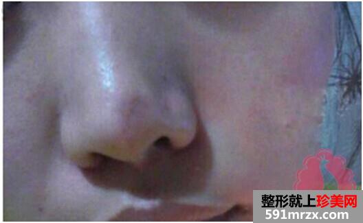 手术,切除,祛疤,恢复,过程,前后,对比,效果,图片