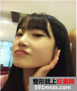 下颌角整形，瓜子脸得来全不费工夫