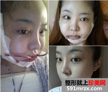 v-line下巴整形手术前后对比照和恢复过程案例分享