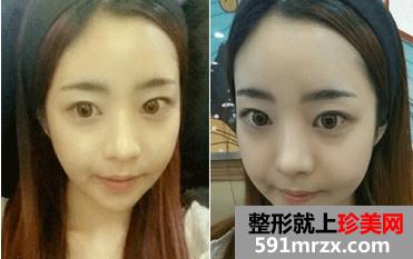 v-line下巴整形手术前后对比照和恢复过程案例分享