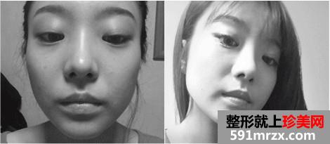 v-line下巴整形手术前后对比照和恢复过程案例分享