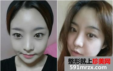 v-line下巴整形手术前后对比照和恢复过程案例分享