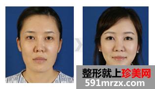 下颌角整形
