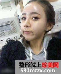 假体隆鼻后效果自然吗 来看看这位美女吧
