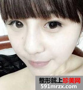 看我的垫下巴手术+玻尿酸隆鼻前后对比 简直就是两个人