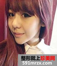 看我的垫下巴手术+玻尿酸隆鼻前后对比 简直就是两个人
