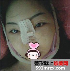一次隆鼻整形让我永久拥有高挺美鼻