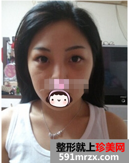 一次隆鼻整形让我永久拥有高挺美鼻