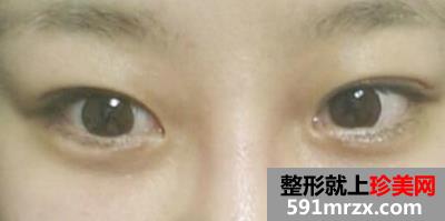 怎样快速消除熊猫眼,激光治疗黑眼圈