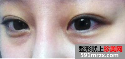 怎样快速消除熊猫眼,激光治疗黑眼圈