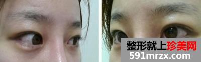怎样快速消除熊猫眼,激光治疗黑眼圈