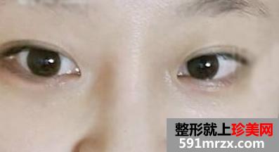 怎样快速消除熊猫眼,激光治疗黑眼圈