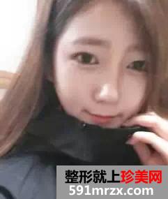驼峰鼻矫正方法,惊艳人生