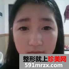 驼峰鼻矫正方法,惊艳人生