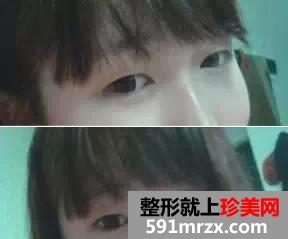 驼峰鼻矫正方法,惊艳人生