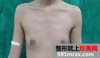 妙桃假体丰胸 满满的B罩杯也不错