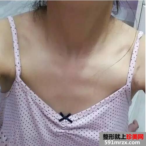做完假体隆胸从飞机场变性感丰满美胸