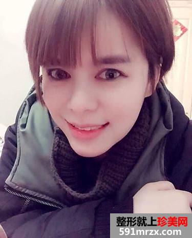 自体脂肪面部填充让我恢复年轻美貌