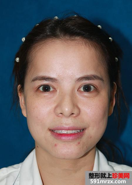 自体脂肪面部填充让我恢复年轻美貌
