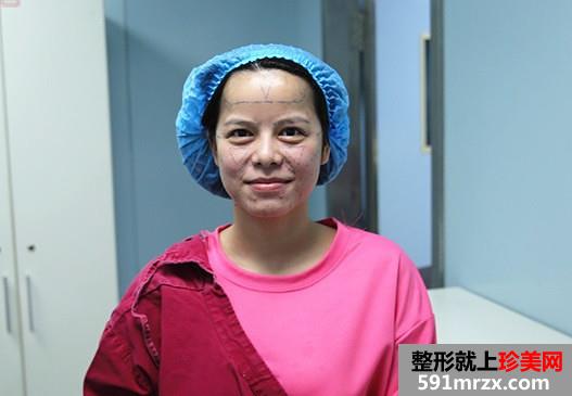自体脂肪面部填充让我恢复年轻美貌
