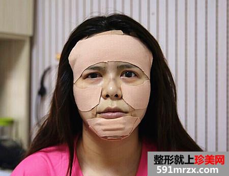 自体脂肪面部填充让我恢复年轻美貌