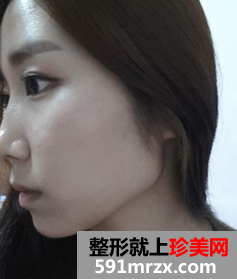 3D回转颧骨术+下颌角磨骨整形前后效果对比图和恢复过程