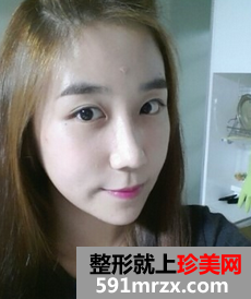 3D回转颧骨术+下颌角磨骨整形前后效果对比图和恢复过程