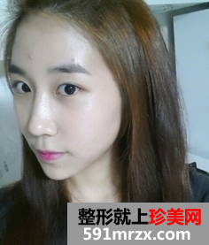 3D回转颧骨术+下颌角磨骨整形前后效果对比图和恢复过程