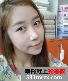 3D回转颧骨术+下颌角磨骨整形前后效果对比图和恢复过程