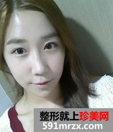 3D回转颧骨术+下颌角磨骨整形前后效果对比图和恢复过程