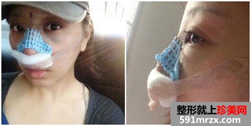 鼻中隔软骨隆鼻+鼻翼缩小术前后照片对比和恢复过程