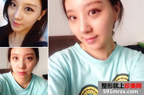 鼻中隔软骨隆鼻+鼻翼缩小术前后照片对比和恢复过程