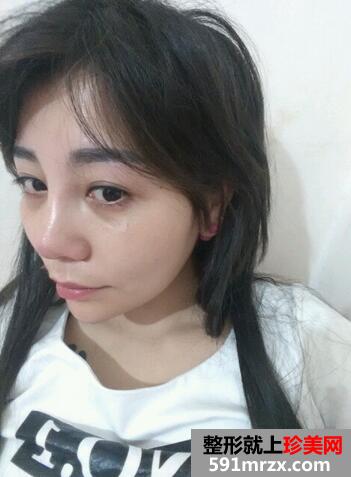涂抹式超声刀提升前后效果对比图和恢复过程分享