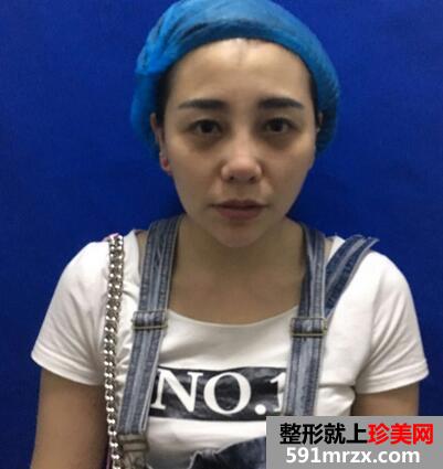 涂抹式超声刀提升前后效果对比图和恢复过程分享