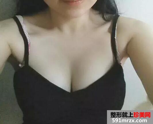 假体隆胸四个月了 手感很好和真实的一样