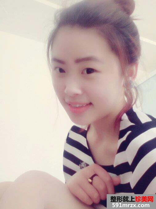我是内双 他们都建议我做双眼皮手术